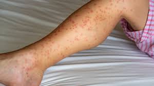 traitement des puces en Isère.