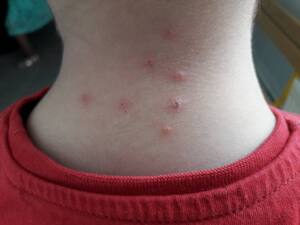 Punaise de lit adulte détectée lors d’un diagnostic professionnel en Isère (38)